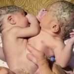 Bayi Kembar Siam Lahirnya Tidak Lazim, Kini Dapatkan Perhatian Dari Bupati Asahan