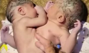 Bayi Kembar Siam Lahirnya Tidak Lazim, Kini Dapatkan Perhatian Dari Bupati Asahan