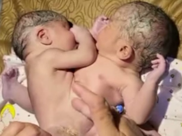 Bayi Kembar Siam Lahirnya Tidak Lazim, Kini Dapatkan Perhatian Dari Bupati Asahan